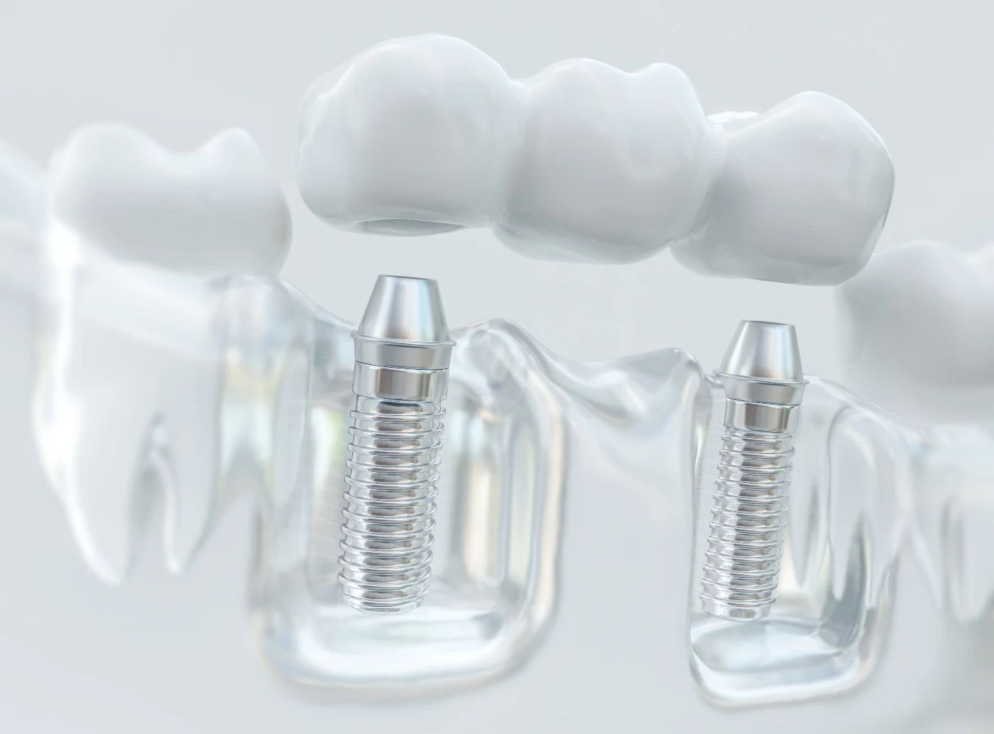 Dental Implants in Georgetown