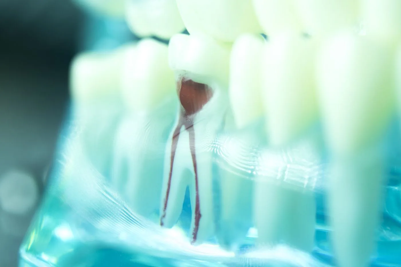 Root Canal Therapy in Georgetown