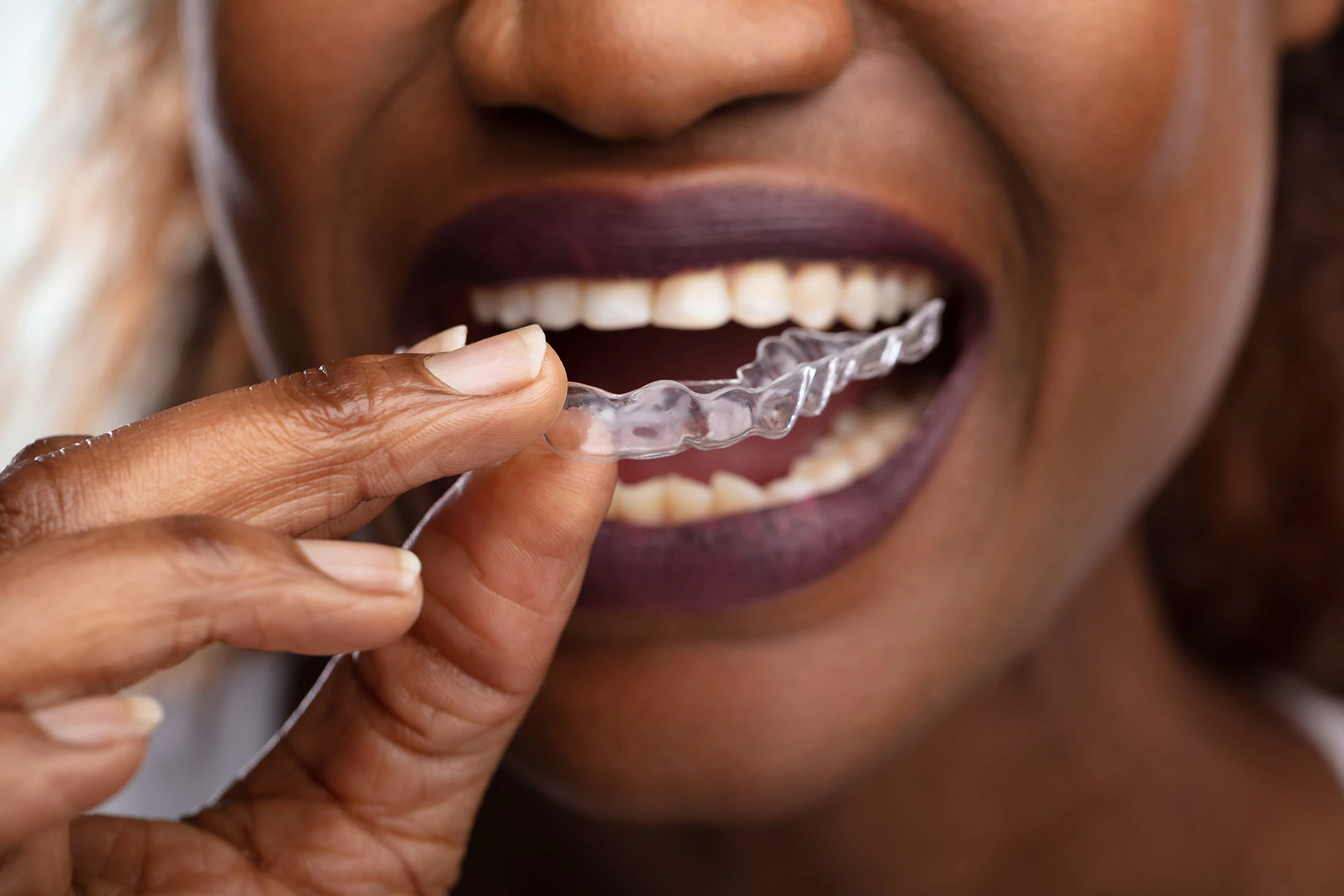 Clear Aligners in Georgetown